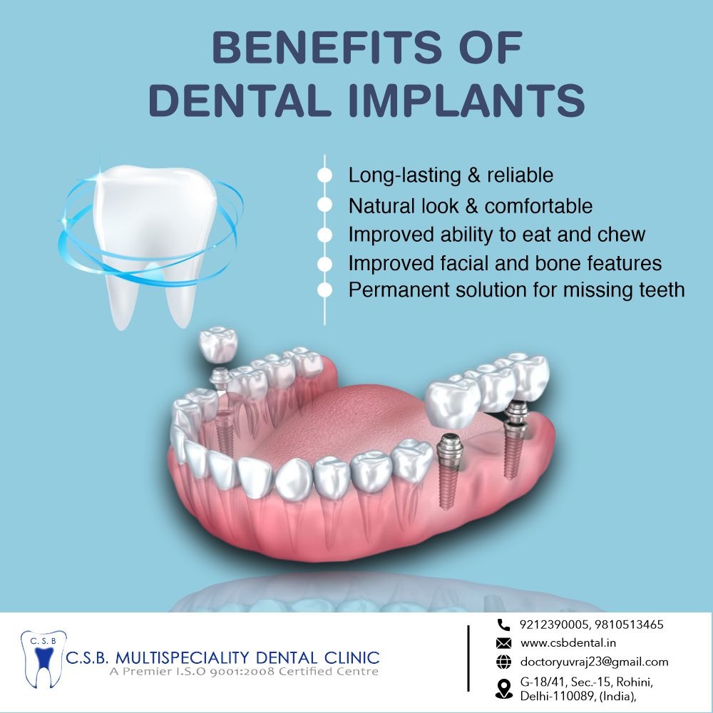 Types of implant in rohini sec 15 delhi